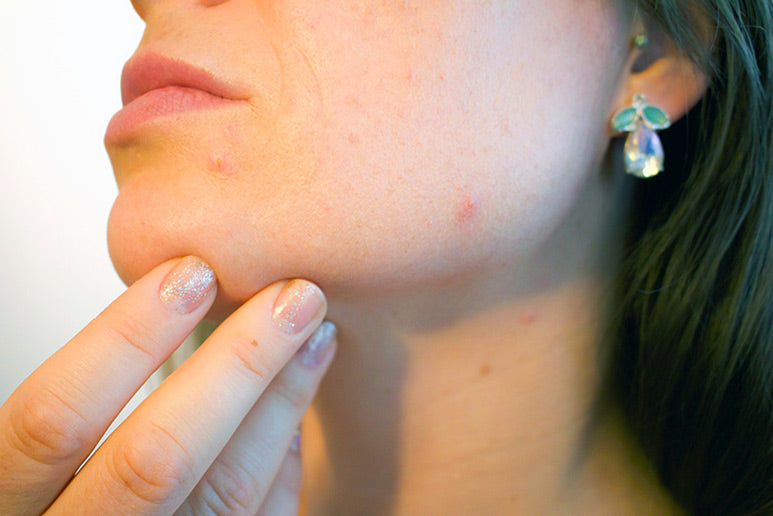 ADULT HORMONAL ACNE AND HOW TO GET RID OF IT: PRODUCTS THAT WORK!