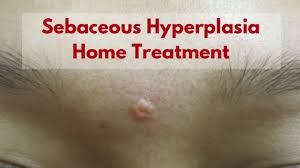 SEBACEOUS HYPERPLASIA TREATMENT, WHAT TOPICAL PRODUCTS HELP?