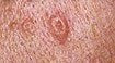 HOW TO GET RID OF SEBACEOUS HYPERPLASIA WITH NCN PRODUCTS